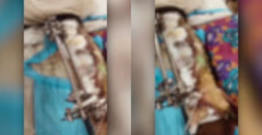 തിരുവനന്തപുരം മെഡിക്കൽ കോളേജിൽ സർജറി കഴിഞ്ഞ് ഐസിയുവിൽ നിന്ന് വാര്‍ഡിലാക്കിയ രോഗിയുടെ കാൽ പുഴുവരിച്ച നിലയിൽ, ബന്ധുക്കളുടെ പ്രതിഷേധം